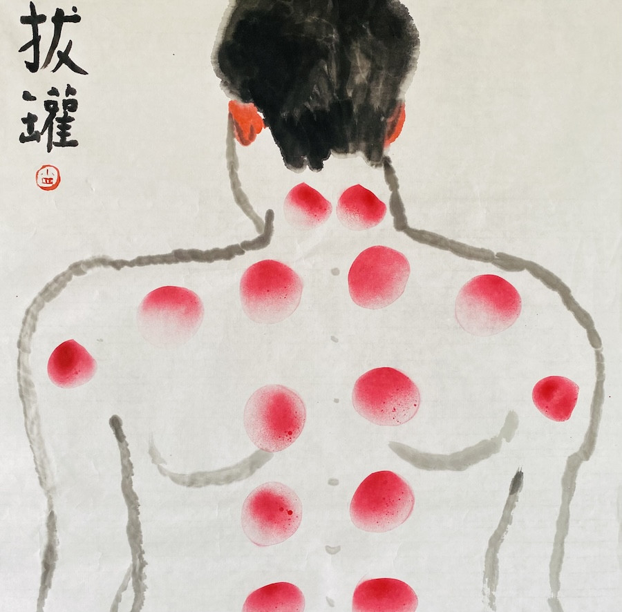 蔡宗祐〈拔罐圖〉。（圖片提供：蔡宗祐）
